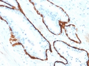 IHC testing of FFPE human prostate carcinoma with Cytokeratin 15 antibody (clone KRT15/2554). Required HIER: boil tissue sections in 10mM citrate buffer, pH 6, for 10-20 min.