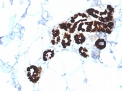 IHC testing of FFPE human basal cell carcinoma with Cytokeratin 15 antibody (clone KRT15/2554). Required HIER: boil tissue sections in 10mM citrate buffer, pH 6, for 10-20 min.