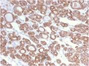 IHC staining of FFPE human thyroid carinoma with recombinant CK18 antibody (clone KRT18/2808R). Required HIER: boil tissue sections in pH 9 10mM Tris with 1mM EDTA for 10-20 min and allow to cool before testing.