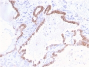 IHC staining of FFPE human colon carinoma with recombinant CK18 antibody (clone KRT18/2808R). Required HIER: boil tissue sections in pH 9 10mM Tris with 1mM EDTA for 10-20 min and allow to cool before testing.