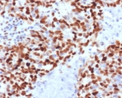 IHC staining of FFPE human colon carcinoma with MSH6 antibody (clone MTS6-1). HIER: boil tissue sections in pH 9 10mM Tris with 1mM EDTA for 10-20 min and allow to cool before testing.