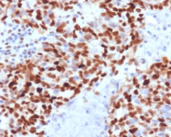 IHC staining of FFPE human colon carcinoma with MSH6 antibody (clone MTS6-1). HIER: boil tissue sections in pH 9 10mM Tris