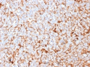 IHC testing of FFPE human breast carcinoma stained with recombinant Mammaglobin antibody (clone MGB/2682R). Required HIER: boiling tissue sections in 10mM citrate buffer, pH6, for 10-20 min followed by cooling at RT for 20 min.