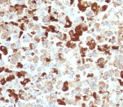 IHC testing of FFPE human melanoma with recombinant NGFR antibody (clone CDLA271-2R). Required HIER: boil tissue sections in pH6, 10mM citrate buffer, for 10-20 min and allow to cool prior to testing.