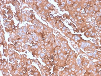 IHC testing of FFPE human colon carcinoma with recombinant MUC1 antibody. Required HIER: boil tissue sections in pH 9 10mM Tris with 1mM EDTA for 10-20 min followed by cooling at RT for 20 min.~