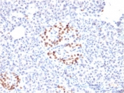 IHC staining of FFPE human pancreas with NKX6.1 antibody (clone NKX61/2561). HIER: boil tissue sections in pH6, 10mM citrate buffer, for 10-20 min and allow to cool before testing.