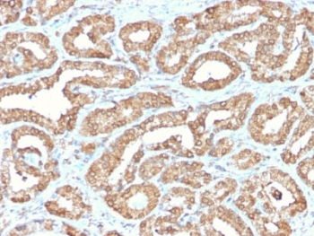 IHC staining of FFPE human prostate tissue with recombinant ODC1 antibody. HIER: boil tissue sections in pH6, 10mM citrate buffer, for 10-20 min and allow to cool before testing.~