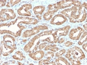IHC staining of FFPE human prostate tissue with recombinant ODC1 antibody (clone ODC1/2878R). HIER: boil tissue sections in pH6, 10mM citrate buffer, for 10-20 min and allow to cool before testing.