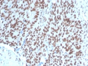IHC staining of FFPE human ovarian carcinoma with PAX2 antibody (clone PAX2/1104). HIER: boil tissue sections in pH 9 10mM Tris with 1mM EDTA for 20 min and allow to cool before testing.