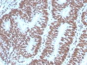IHC staining of FFPE human colon carcinoma with PAX2 antibody (clone PAX2/1104). HIER: boil tissue sections in pH 9 10mM Tris with 1mM EDTA for 20 min and allow to cool before testing.