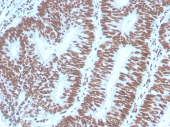 IHC staining of FFPE human colon carcinoma with PAX2 antibody (clone PAX2/1104). HIER: boil tissue sections in pH 9 10mM Tris with 1mM EDTA for 20 min and allow to cool before testing.