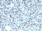 IHC staining of FFPE human renal cell carcinoma with PAX2 antibody (clone PAX2/1104). HIER: boil tissue sections in pH 9 10mM Tris with 1mM EDTA for 20 min and allow to cool before testing.