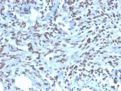 IHC staining of FFPE human renal cell carcinoma with PAX2 antibody (clone PAX2/1104). HIER: boil tissue sections in pH 9 10mM Tris with 1mM EDTA for 20 min and allow to cool before testing.