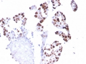 IHC staining of FFPE human breast carcinoma with POLR2A antibody (clone CTD 4H8). HIER: boil tissue sections in pH6, 10mM citrate buffer, for 10-20 min and allow to cool before testing.