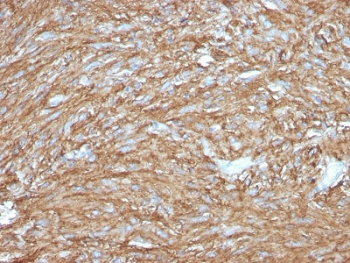 IHC testing of FFPE human gastrointestinal stromal tumor (GIST) with TMEM16A antibody (clone DG1/2831R). Required HIER: boil tissue sections in pH 9 10mM Tris with 1mM EDTA for 10-20 min followed by cooling at RT for 20 min.~