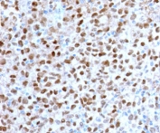 IHC staining of FFPE human melanoma with recombinant MITF antibody (clone MPAF3-2R). HIER: boil tissue sections in pH 9 10mM Tris with 1mM EDTA for 10-20 min and allow to cool before testing.