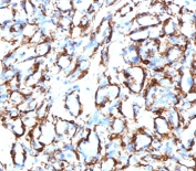 IHC testing of FFPE human angiosarcoma with recombinant CD34 antibody (clone CDLA34-2R). Required HIER: boil tissue sections in 10mM Tris with 1mM EDTA, pH 9, for 10-20 min followed by cooling at RT for 20 min.