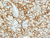 IHC testing of FFPE human renal cell carcinoma with recombinant CD34 antibody (clone CDLA34-2R). Required HIER: boil tissue sections in 10mM Tris with 1mM EDTA, pH 9, for 10-20 min followed by cooling at RT for 20 min.
