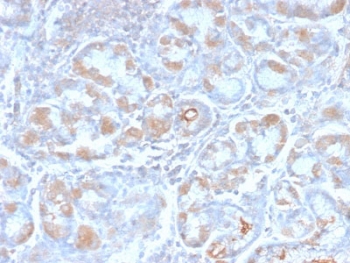 IHC staining of FFPE human stomach carcinoma with recombinant pS2 antibody (clone TFF1/2969R). HIER: boil tissue sections in pH6, 10mM citrate buffer, for 10-20 min and allow to cool before testing.~