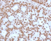 IHC testing of FFPE human endometrial carcinoma with recombinant TLE1 antibody (clone TLEP1-2R). Required HIER: boil tissue sections in pH 9 10mM Tris with 1mM EDTA for 10-20 min and allow to cool before testing.