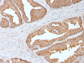 IHC testing of FFPE human prostate carcinoma with Ezrin antibody. Required HIER: boiling tissue sections in 10mM citrate buffer, pH 6, for 10-20 min and allow to cool prior to staining.~