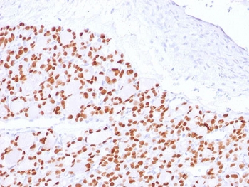IHC testing of FFPE human thyroid with PAX8 antibody. Required HIER: boil tissue sections in 10mM Tris buffer with 1mM EDTA, pH 9, for 10-20 min and allow to cool before testing.~