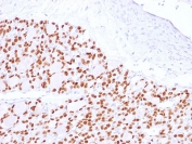 IHC testing of FFPE human thyroid with PAX8 antibody (clone PAX8/2774R). Required HIER: boil tissue sections in 10mM Tris buffer with 1mM EDTA, pH 9, for 10-20 min and allow to cool before testing.