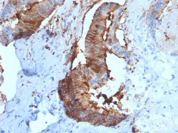 IHC testing of FFPE human renal cell carcinoma with Cathepsin D antibody (clone CTSD/2781). HIER: boil tissue sections in pH6, 10mM citrate buffer, for 10-20 min followed by cooling at RT for 20 min.~