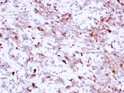IHC testing of FFPE human liver tissue with Cathepsin K antibody (clone CTSK/2791). HIER: boil tissue sections in pH6, 10mM citrate buffer, for 10-20 min followed by cooling at RT for 20 min.