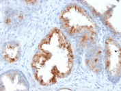 IHC testing of FFPE human prostate carcinoma with AMACR antibody (clone AMACR/1864). Required HIER: steam section in pH6 citrate buffer for 20 min and allow to cool prior to staining.