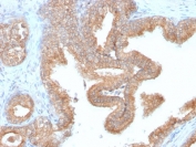 IHC testing of FFPE human prostate carcinoma with recombinant AMACR antibody (clone AMACR/2748R). Required HIER: steam section in pH6 citrate buffer for 20 min and allow to cool prior to staining.