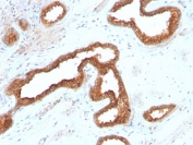 IHC testing of FFPE human renal cell carcinoma with recombinant AMACR antibody (clone AMACR/2748R). Required HIER: steam section in pH6 citrate buffer for 20 min and allow to cool prior to staining.