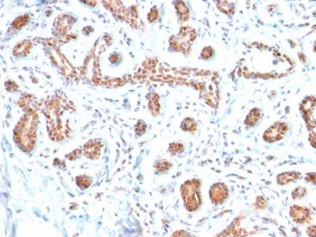 IHC testing of FFPE human breast carcinoma with GATA3 antibody. Required HIER: boil tissue sections in 10mM citrate buffer, pH 6, for 10-20 min and allow to cool prior to testing.~