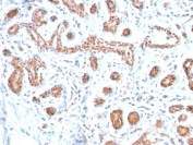 IHC testing of FFPE human breast carcinoma with GATA3 antibody (clone GATA3/2446). Required HIER: boil tissue sections in 10mM citrate buffer, pH 6, for 10-20 min and allow to cool prior to testing.