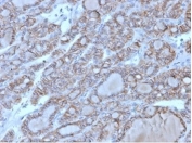 IHC staining of FFPE human thyroid tissue with CD56 antibody (clone 56C04/123A8). HIER: boil tissue sections in pH9 EDTA buffer for 10-20 min followed by cooling at RT for 20 min.
