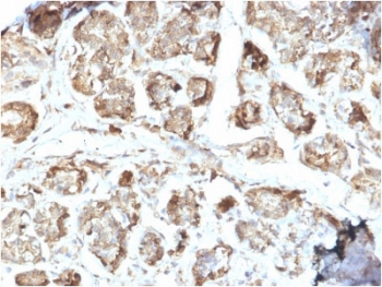 IHC staining of FFPE human breast carcinoma with NME2 antibody. HIER: boil tissue sections in pH6, 10mM citrate buffer, for 10-20 min and allow to cool before testing.
