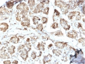 IHC staining of FFPE human breast carcinoma with NME2 antibody (clone CPTC-NME2-2). HIER: boil tissue sections in pH6, 10mM citrate buffer, for 10-20 min and allow to cool before testing.