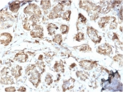 IHC staining of FFPE human breast carcinoma with NME2 antibody (clone CPTC-NME2-2). HIER: boil tissue sections in pH6, 10mM citrate buffer, for 10-20 min and allow to cool before testing.