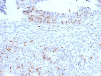 IHC staining of FFPE human colon carcinoma with RAD51 antibody. HIER: boil tissue sections in pH 9 10mM Tris with 1mM EDTA for 10-20 min and allow to cool before testing.