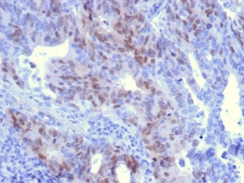 IHC staining of FFPE human colon carcinoma with RAD51 antibody. HIER: boil tissue sections in pH 9 10mM Tris with 1mM EDTA for 10-20 min and allow to cool before testing.
