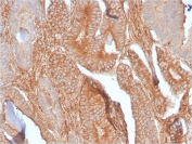 IHC staining of FFPE human prostate carcinoma with recombinant CD81 antibody (clone C81/2885R). HIER: boil tissue sections in 10mM Tris with 1mM EDTA, pH 9, for 10-20 min followed by cooling prior to testing.