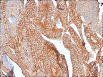 IHC staining of FFPE human prostate carcinoma with recombinant CD81 antibody (clone C81/2885R). HIER: boil tissue sections in 10mM Tris with 1mM EDTA, pH 9, for 10-20 min followed by cooling prior to testing.~