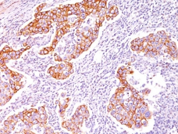 IHC staining of human breast carcinoma with p-Tyr antibody (clone SPM102). ~