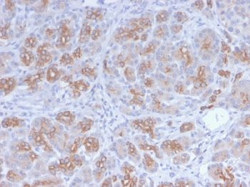 IHC staining of FFPE human breast carcinoma with recombinant Golgi antibody (clone GLG1/2829R). HIER: boil tissue sections in pH 9 10mM Tris with 1mM EDTA for 10-20 min and allow to cool before testing.~