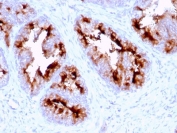 IHC testing of FFPE human prostate carcinoma with FOLH1 antibody (clone FOLH1/2363). Required HIER: boil tissue sections in pH 9 10mM Tris with 1mM EDTA for 10-20 min and allow to cool before testing.