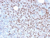 IHC staining of FFPE human melanoma with recombinant MITF antibody (clone MITF/2987R). HIER: boil tissue sections in pH 9 10mM Tris with 1mM EDTA for 10-20 min and allow to cool before testing.