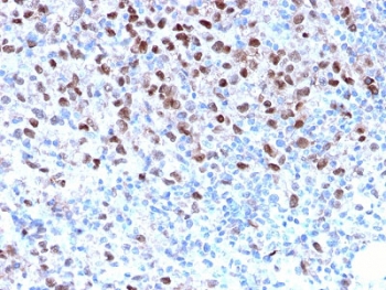 IHC staining of FFPE human melanoma with recombinant MITF antibody. HIER: boil tissue sections in pH 9 10mM Tris with 1mM EDTA for 10-20 min and allow to cool before testing.~