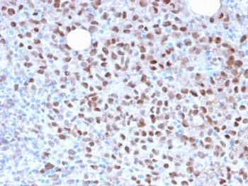 IHC staining of FFPE human melanoma with recombinant MITF ant