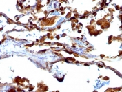 IHC testing of FFPE human lung carcinoma with MUC1 antibody (clone VU-4H5). HIER: requires steaming of sections in pH 9 10mM Tris with 1mM EDTA for 10-20 min and allow to cool before testing.
