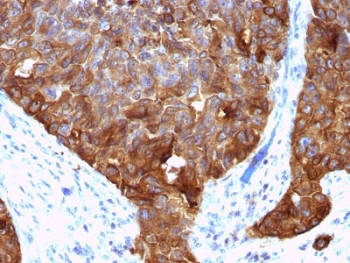 IHC testing of FFPE human colon carcinoma with MUC1 antibody (clone VU-4H5). HIER: requires steaming of sections in pH 9 10mM Tris with 1mM EDTA for 10-20 min and allow to cool before testing.~